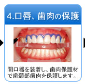 4.口唇、歯肉の保護